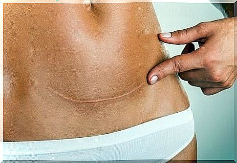 woman pointing at her scar on her stomach