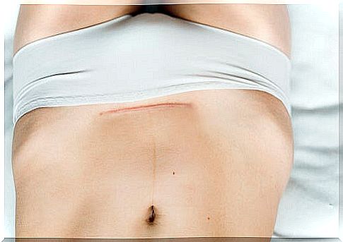 abdomen with scars from cesarean section